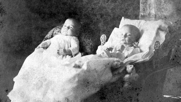 Fotos de bebês gêmeos com o da direita morto.